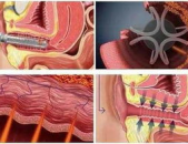 私密激光的分类,技术革新与个性化治疗解析